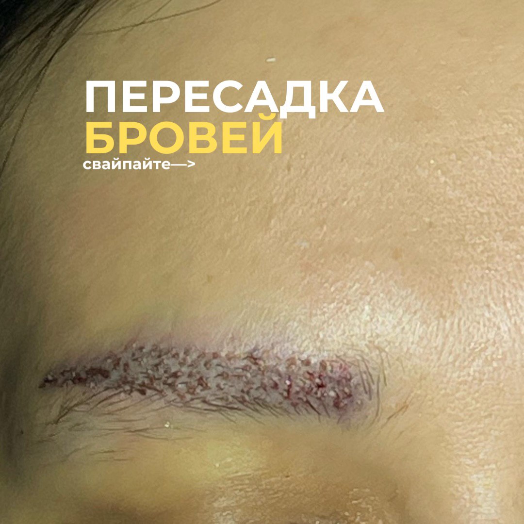 Трансплантация бровей — до
