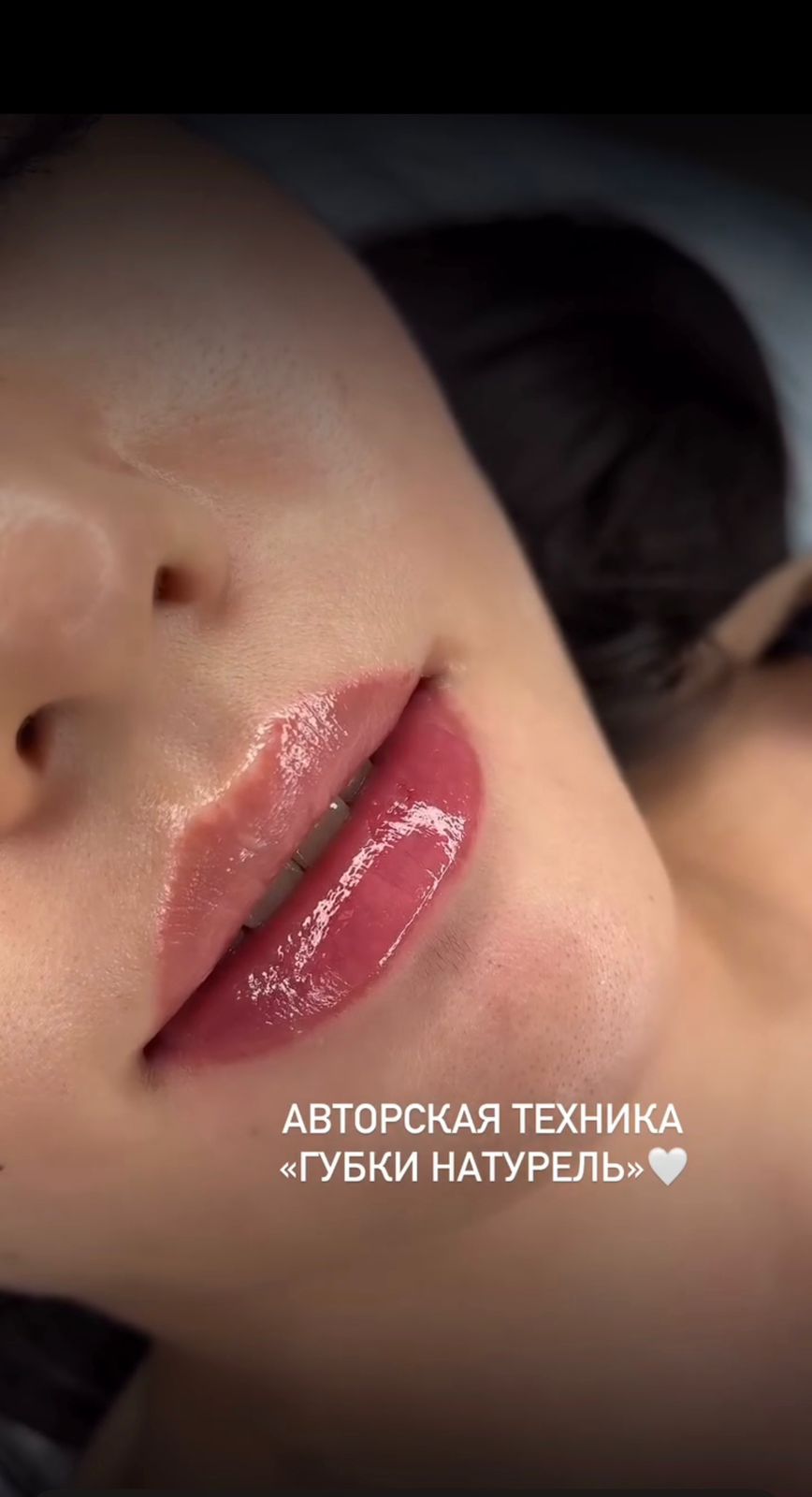 Контурная пластика губ — техника «Губки Натурель»
