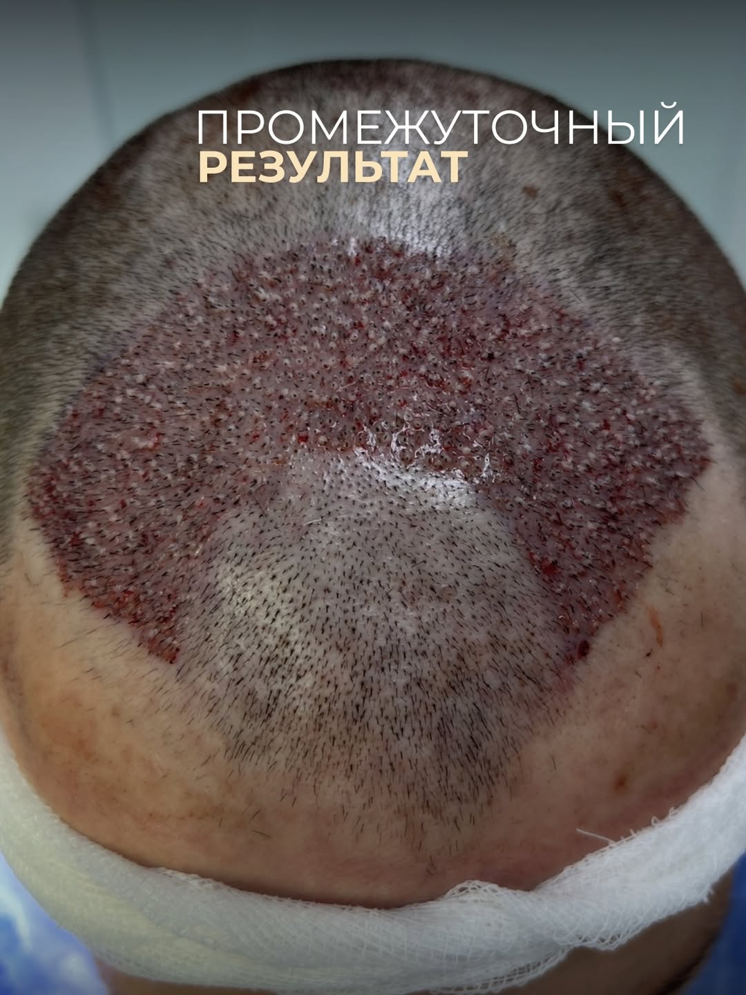 Пересадка волос — пациент 1, этап 1