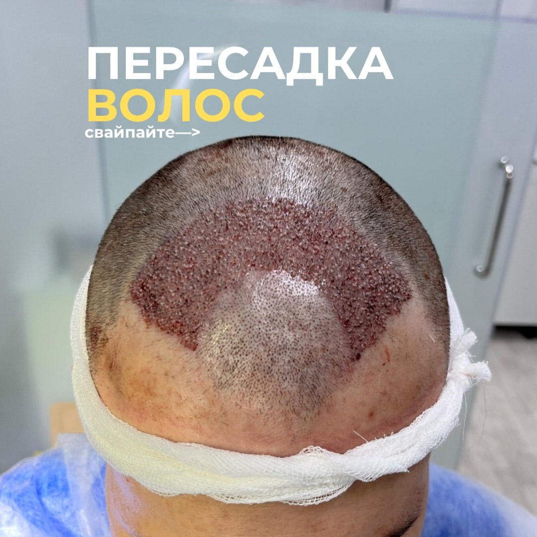 Пересадка волос — пациент 1, результат 1