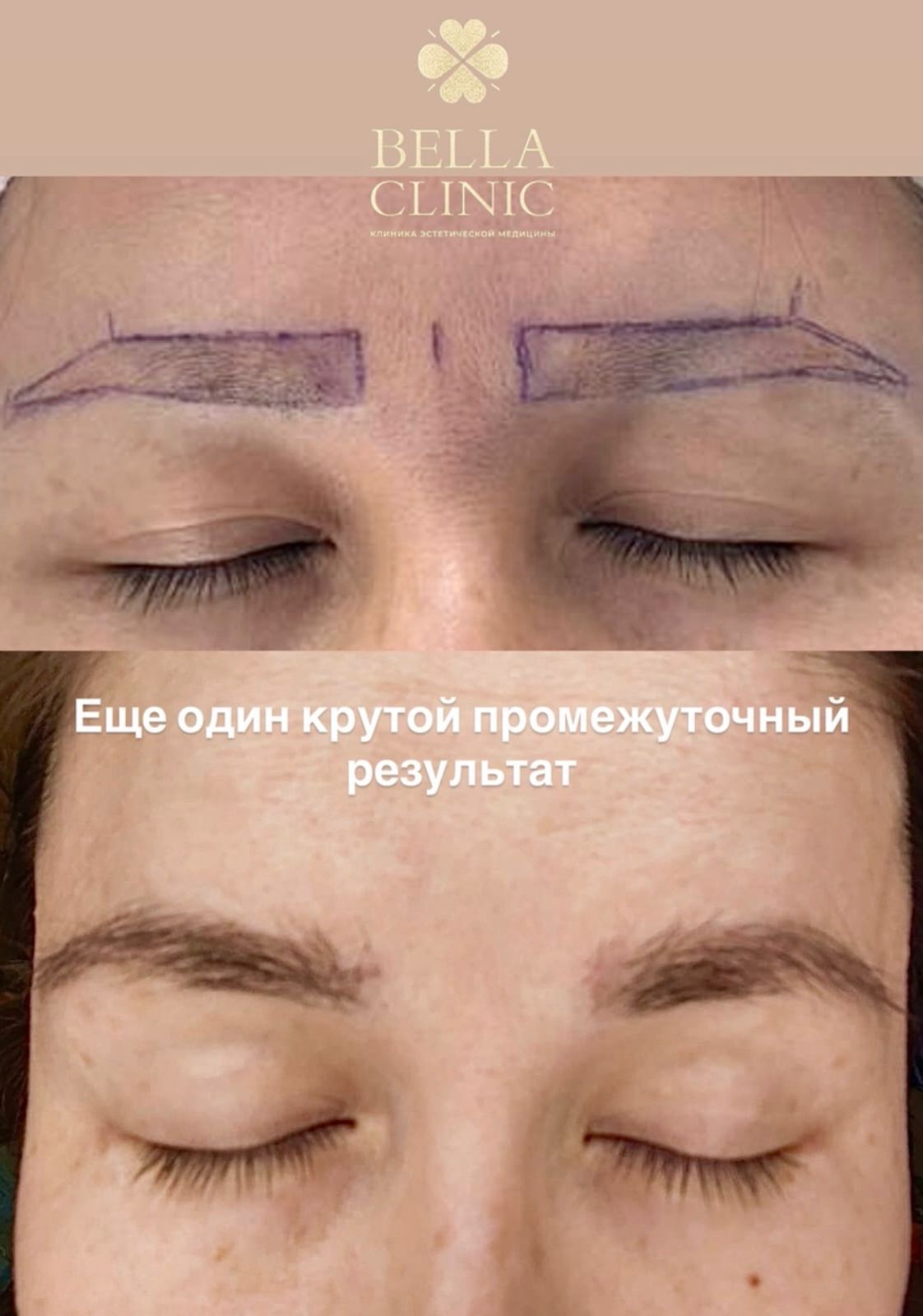 Пересадка бровей — промежуточный результат Bella Clinic